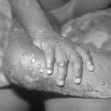 サル痘に感染した4歳女児の右腕と右足に生じた病変。1971年にリベリアで撮影。Close-up of monkeypox lesions on the arm and leg of a female child. Human infection with monkeypox-like virus in 4 year-old female in Bondua, Grand Gedeh County, Liberia. This infection was caused by a pox virus of the vaccinia, variola, monkeypox type.(CDC’s Public Health Image Library) 