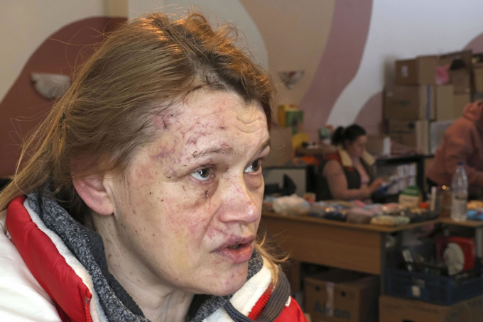 ミサイルによる爆風が襲った瞬間を振り返るオレナ・コシノワさん。顔にはいくつもの傷が残っていた＝2024年1月13日、キーウ（共同）